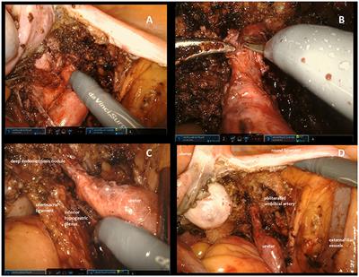 Robotic Approach to Ureteral Endometriosis: Surgical Features and Perioperative Outcomes